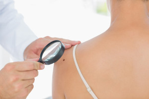 Doctor examining melanoma on woman with magnifying glass in clin