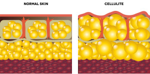 Cellulite and normal skin.