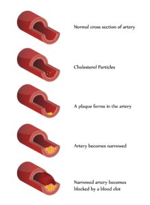 Artery and Atherosclerosis