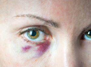 bruise under an eye. Cosmetology. The prick got to a vessels