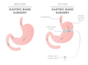 Gastric Band for Weight Loss.  If you Tighten or Loosen it, It L