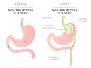 Gastric Bypass for Weight Loss - You Are Actually Re-routing You